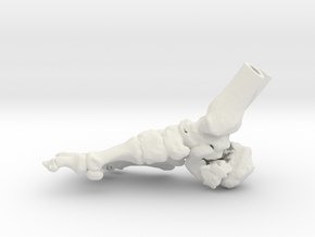 Foot and Ankle - Calcaneal Fracture (SKU 022) in White Natural Versatile Plastic