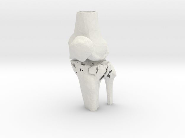 Knee - Proximal Tibia Fracture (SKU 005) in White Natural Versatile Plastic