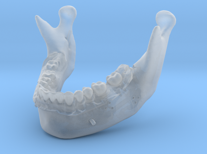 Subject 0.h | Mandible (After) 3d printed