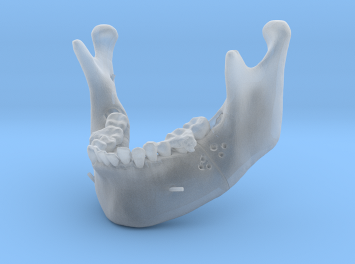 Subject 2a | Mandible (Before IMDO) 3d printed