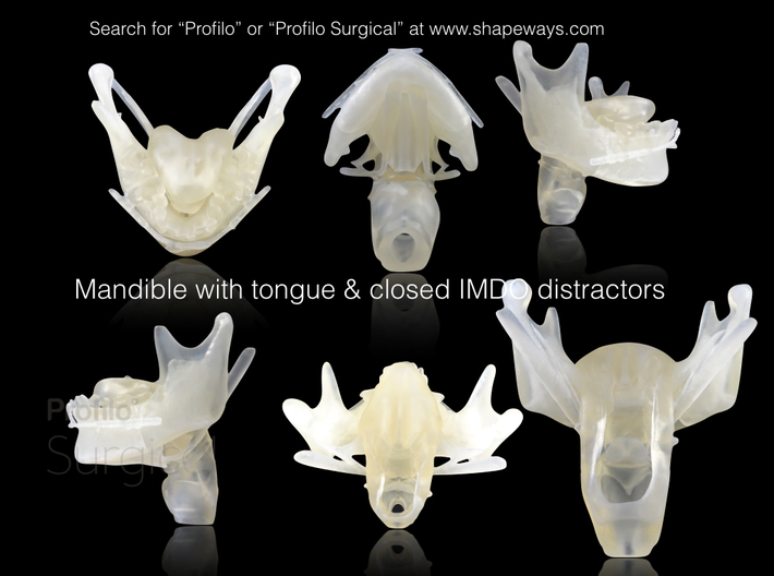 Subject 2d | Mandible + Tongue + Distractors (Befo 3d printed Printed model