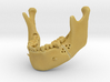 Subject 2a | Mandible (Before IMDO) 3d printed 